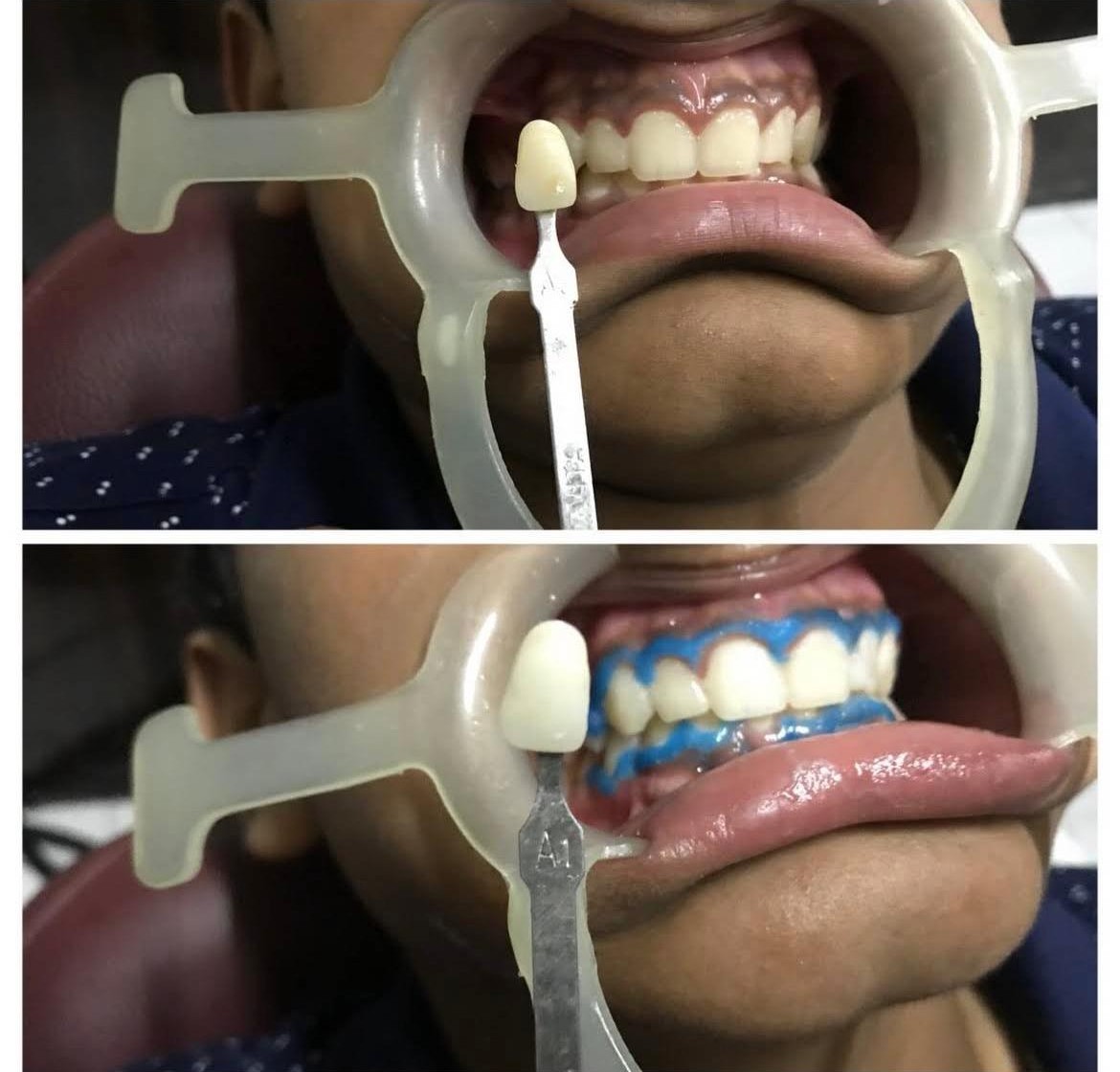 Laser Teeth Whitening
